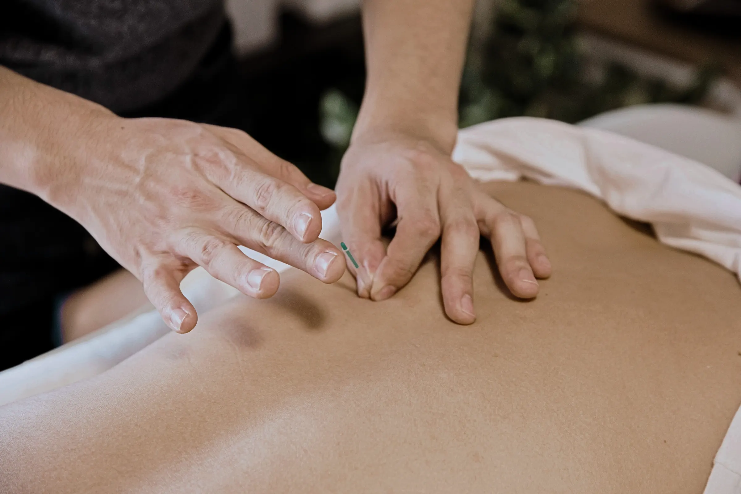 Medical Acupuncture at Altitude Physiotherapy